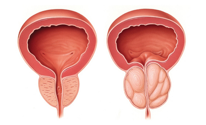 Prostatin